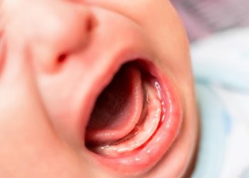 Balita Diduga Digigit di Daycare, Orang Tua Melapor ke Polisi