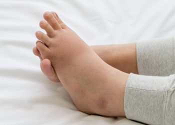 Kaki Bengkak Akibat Kerusakan Ginjal dan Ciri-cirinya