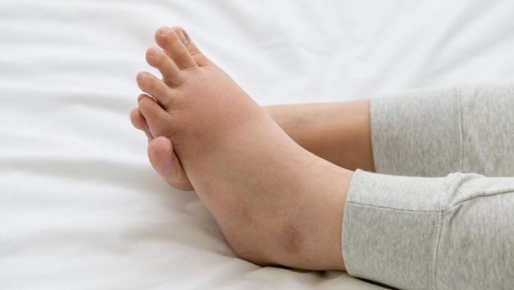 Kaki Bengkak Akibat Kerusakan Ginjal dan Ciri-cirinya