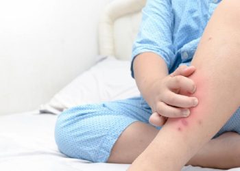 Bercak Merah di Kulit Tanpa Gatal Tanda 7 Penyakit yang Perlu Diketahui