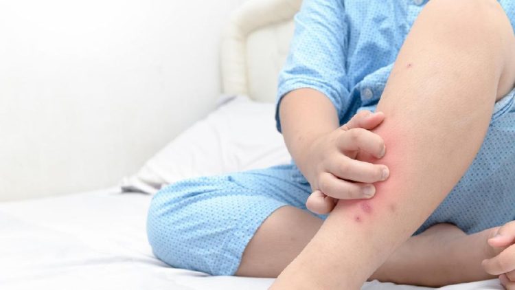 Bercak Merah di Kulit Tanpa Gatal Tanda 7 Penyakit yang Perlu Diketahui