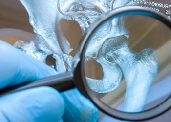 Asam Urat Penyebab Sakit Ginjal Ini Penjelasannya