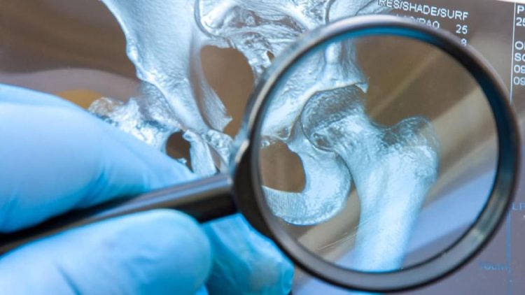 Asam Urat Penyebab Sakit Ginjal Ini Penjelasannya