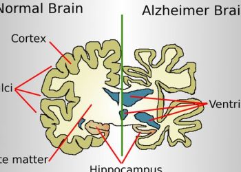 Ciri-Ciri Alzheimer yang Perlu Dikenali agar Tidak Salah Pahami