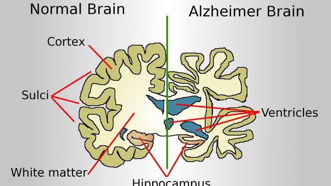 Ciri-Ciri Alzheimer yang Perlu Dikenali agar Tidak Salah Pahami
