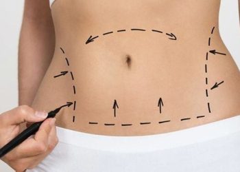 Tanpa Sedot Lemak Ada 6 Cara Efektif Menghilangkan Buncit di Perut