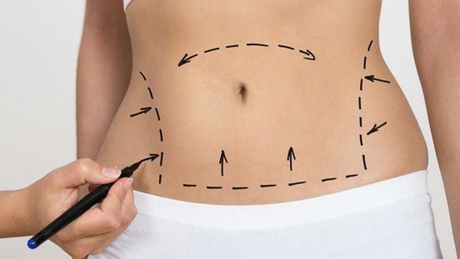 Tanpa Sedot Lemak Ada 6 Cara Efektif Menghilangkan Buncit di Perut