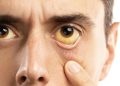 8 Alasan Mata Menguning Selain Hepatitis