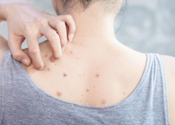 Jerawat di Punggung yang Membandel, Coba 8 Cara Mengatasinya