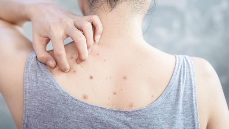 Jerawat di Punggung yang Membandel, Coba 8 Cara Mengatasinya