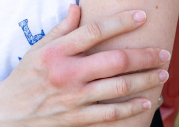 5 Cara Alami Mengatasi Bengkak Akibat Sengatan Tawon