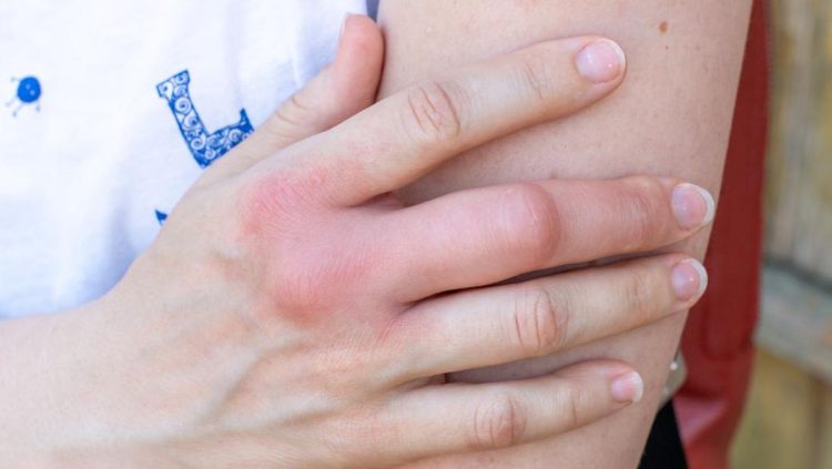 5 Cara Alami Mengatasi Bengkak Akibat Sengatan Tawon