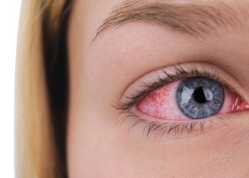 Urat Merah di Mata Berbahaya atau Tidak Ini Penjelasannya