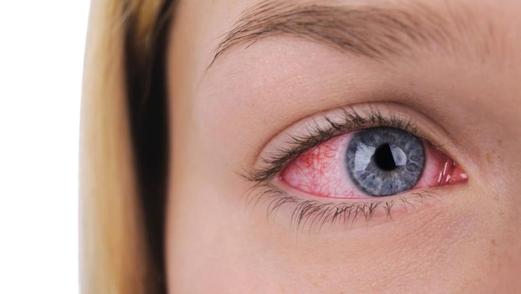 Urat Merah di Mata Berbahaya atau Tidak Ini Penjelasannya