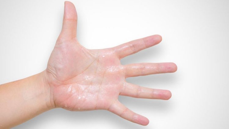 7 Cara Efektif Mengatasi Tangan Panas Akibat Cabai