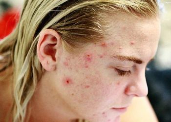 Kaitan Jerawat dengan Kesehatan Mental Menurut Penjelasan Dokter