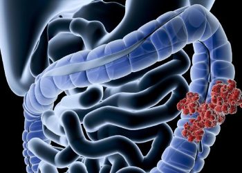 Gen Z Rentan Kanker Usus Besar, Makanan Ini Penyebab Utamanya