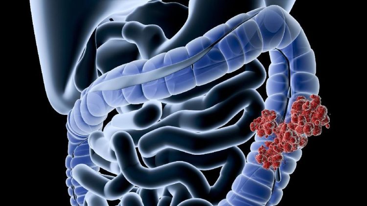 Gen Z Rentan Kanker Usus Besar, Makanan Ini Penyebab Utamanya